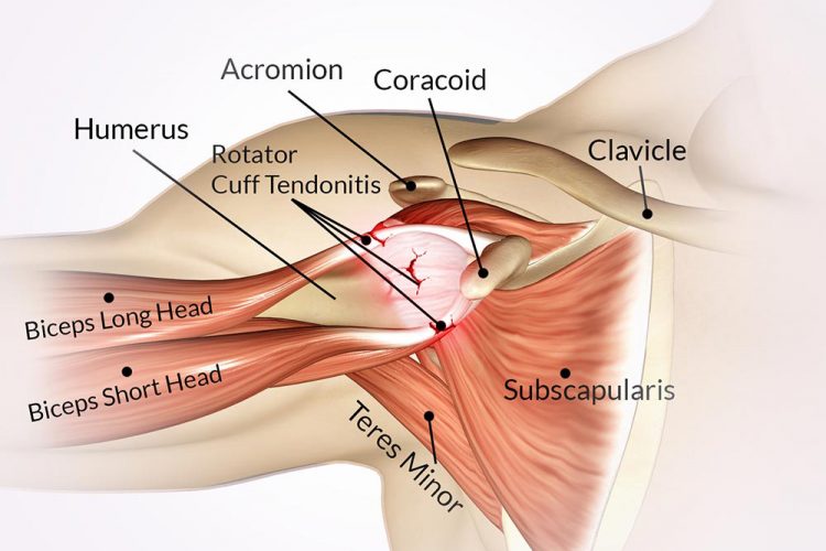 What Shoulder Impingement Is and How to Diagnose and Treat It